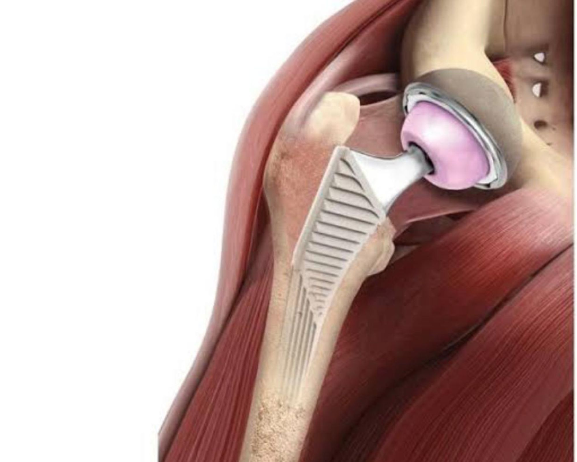 Imagem JPG, Santa Casa de Barretos é pioneira em nova abordagem cirúrgica para implantação de prótese de quadril